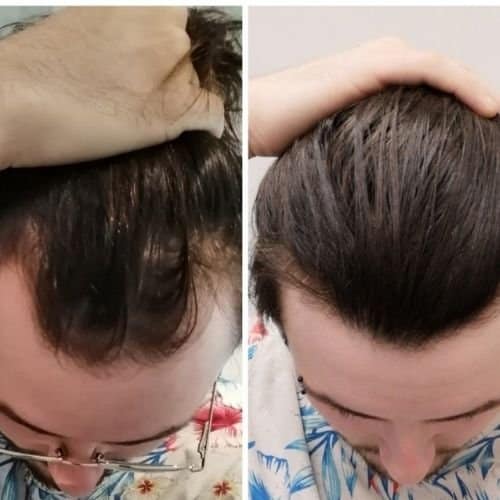 minoxidil-antes-e-depois-calvicie